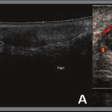 Area of complete rupture of the calcaneal tendon (A). Note increased ...