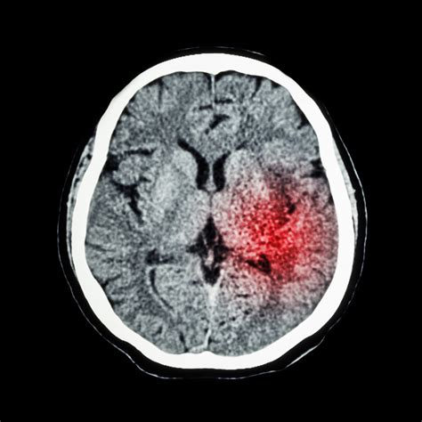 CT scan of brain show Ischemic Stroke or Hemorrhagic Stroke - Home - Home