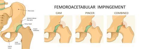 Hip Impingement - Causes & Best Treatment Options in 2022