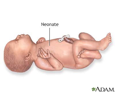 Moro reflex Information | Mount Sinai - New York