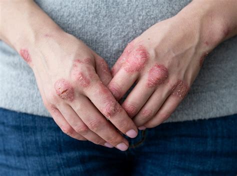 The Surprising Autoimmune Skin Disease-Gut Health Connection
