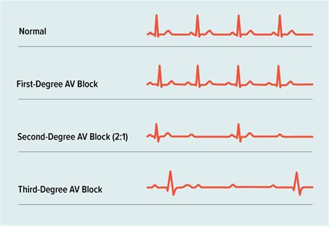 Second-Degree Heart Block: Symptoms, Causes, Treatment, Outlook