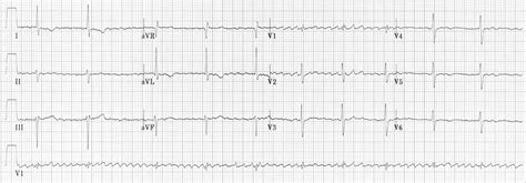 Junctional Escape Rhythm • LITFL • ECG Library Diagnosis