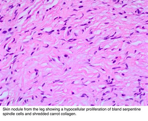 Plexiform Schwannoma Pathology Outlines - kevinjoblog