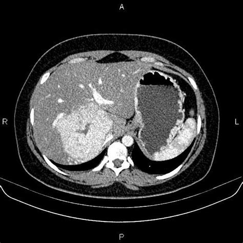 Focal Nodular Hyperplasia Liver - cloudshareinfo