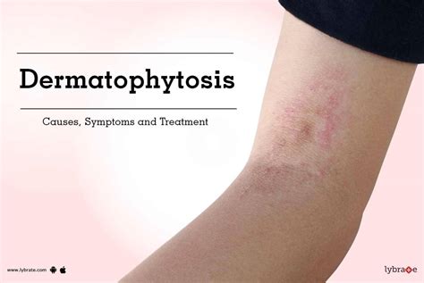 Dermatophytosis: Causes, Symptoms and Treatment - By Dr. Anshu Aggarwal | Lybrate