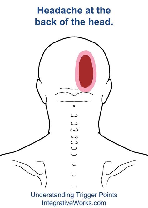 headache | | Integrative Works | Headache back of head, Headache on ...