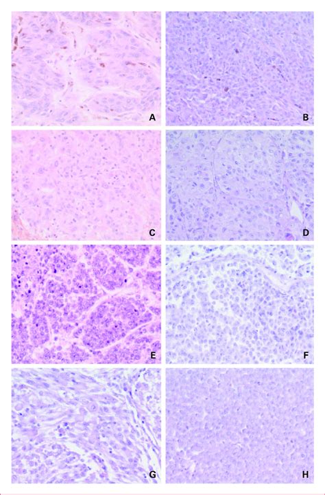 Histopathologic features of four patient tumors and corresponding... | Download Scientific Diagram