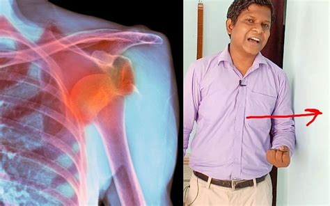 17 Best Shoulder Dislocation Exercises to prevent recurrence : Physiosunit