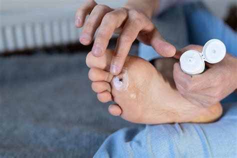 Ways of Treating Foot and Toe Ulcers