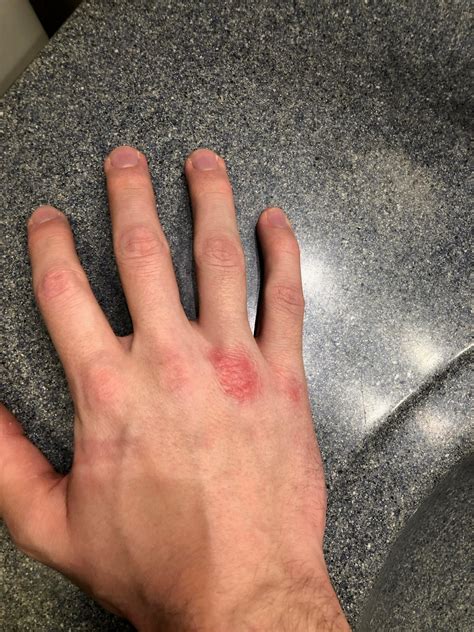 Psoriasis On Knuckles