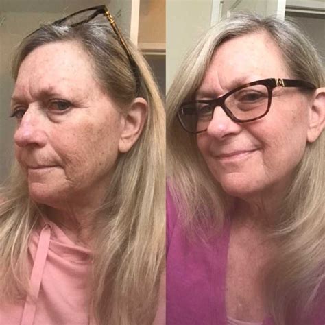 Tretinoin Before And After Wrinkles
