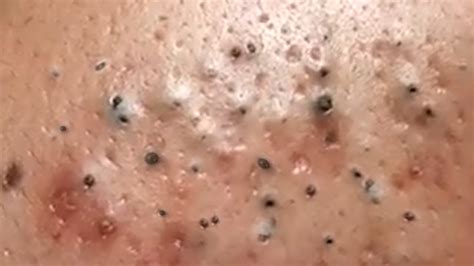 Blackhead Extractions | Blackheads Removal | Acne Treatment | Big Cystic Acne Extraction