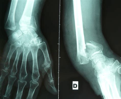 Fracture du poignet - Institut Européen de la Main