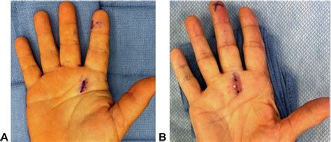 Trigger Finger Release: Are Sutures Requiring Removal Necessary ...