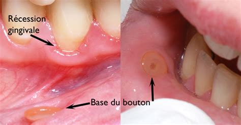 Infection Du Piercing De La Langue