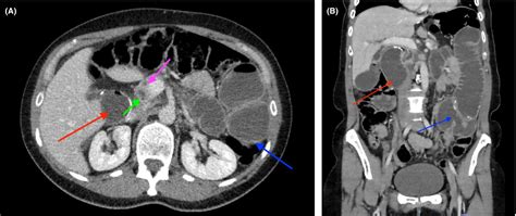 Afferent loop syndrome 7‐years post Roux‐en‐Y gastrojejunostomy: An ...