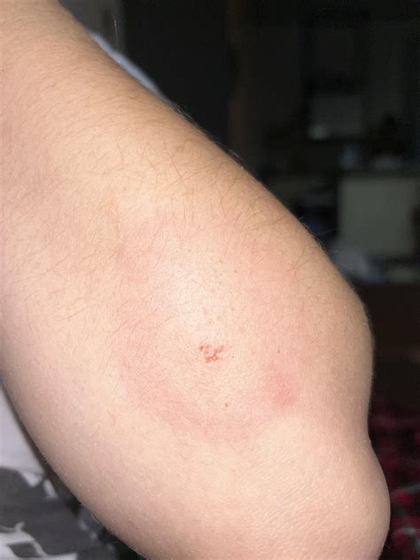 bullseye rash around bedbug bite?? : r/DermatologyQuestions