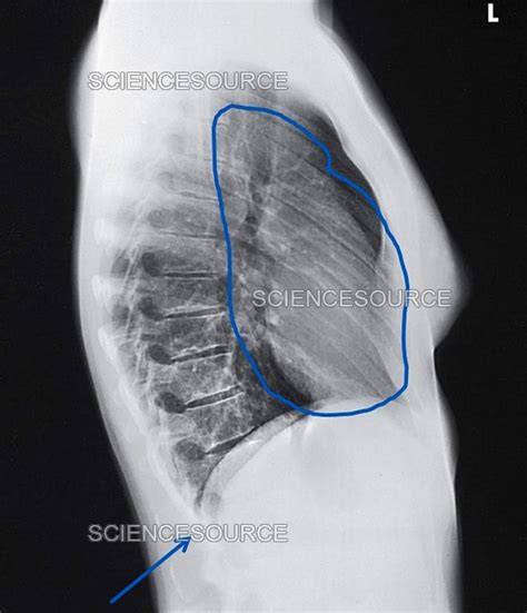 Normal Lateral Chest Xray Normal chest x-ray | Radiology Case ...