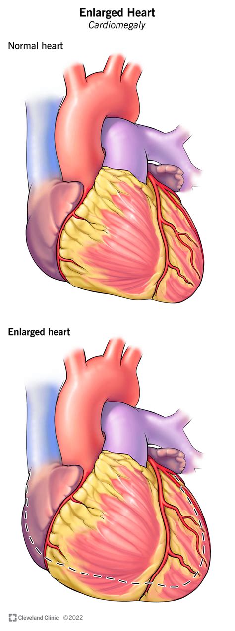 Enlarged Human Heart Enlarged Heart: Symptoms And Causes | Bottom Line