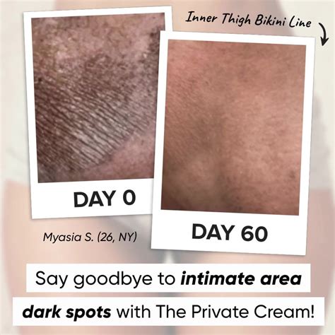 Treat Intimate-Area Dark Spots with The Private Cream