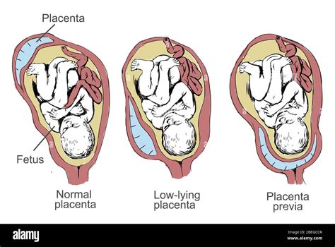 Placenta Previa, Illustration Stock Photo - Alamy