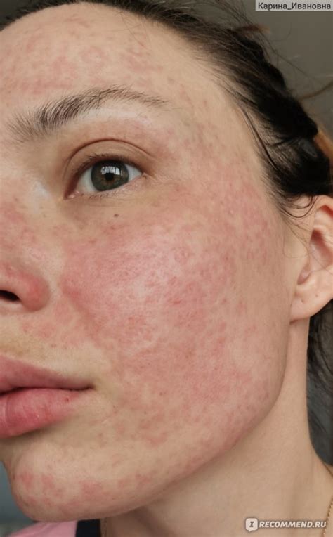 Холодная плазма - «Хорошая альтернатива сезонному серединному пилингу ...