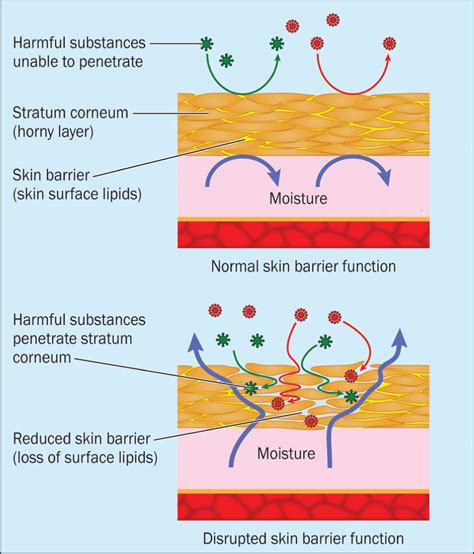 Incontinence Skin Breakdown at Lachlan Ricardo blog