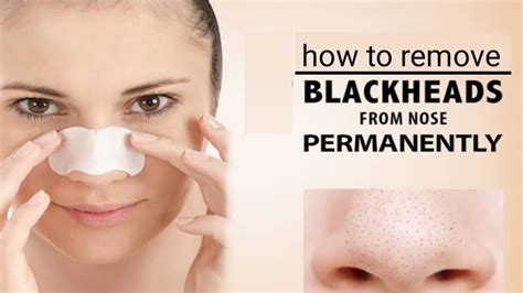 remove blackheads from nose || Super Satisfying Blackhead Removal - YouTube