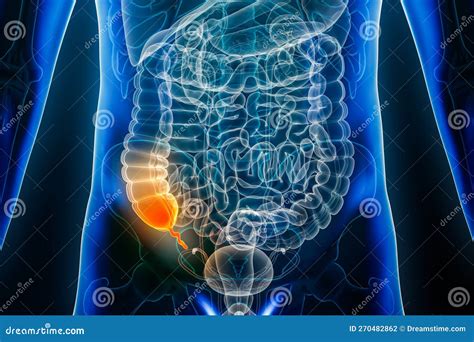 Appendicite Maladie Ou Inflammation De L'appendice Vermiforme 3d ...