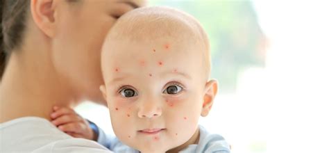 Varicelle bébé : tout savoir sur la varicelle et ses symptômes | Babybio