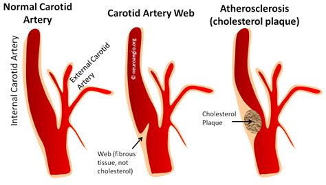 Carotid Artery Web | neuroangio.org