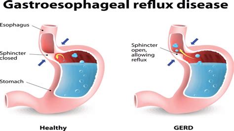 Esophagitis - Causes & Treatment for Eosinophilic, Reflux & Erosive