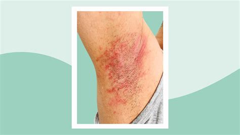 Armpit Rash: Possible Causes, How to Treat It, and Pictures