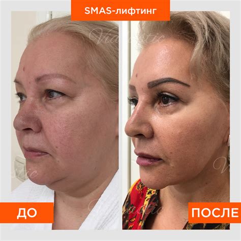 Холодная Плазма Для Лица Отзывы - 25 Фотo