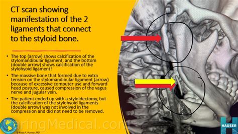 Stylomandibular Ligament