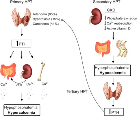 Manifestations of hyperparathyroidism in the jaws: Concepts, mechanisms ...