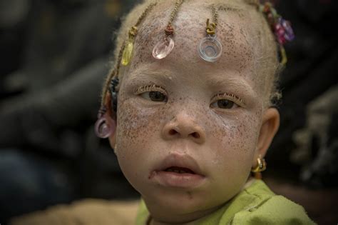 Journée internationale de sensibilisation à l'albinisme : le cri du ...