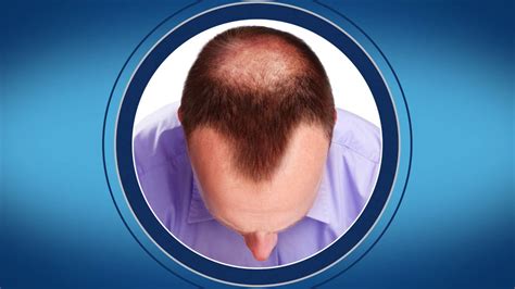 La calvitie masculine, ses causes et son traitement (alopécie androgénétique) | ROGAINE® pour hommes