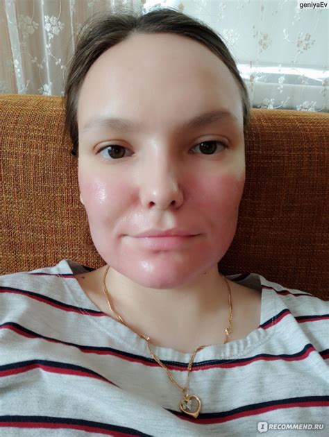 Холодная плазма - «Заметна ли разница? Постакне после двух процедур ...