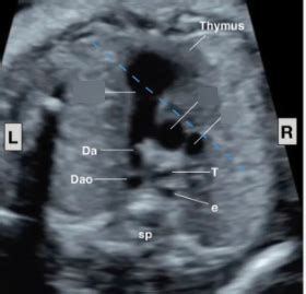 3VV Heart View Diagram | Quizlet