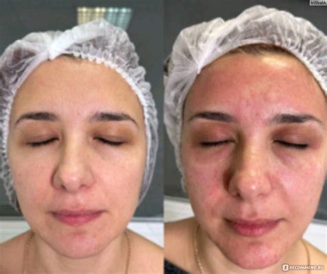 Холодная плазма - «Реальность или миф омоложение холодной плазмой ...