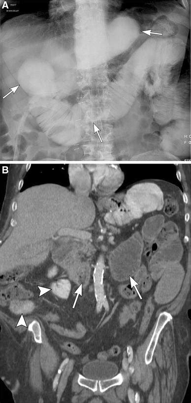 Afferent loop syndrome after R-Y bypass. A 66-year-old male with ...