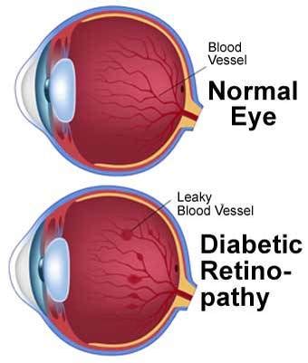Diabetic Eye Disease - academy of eye care