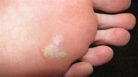 Plantar Warts: Symptoms, Causes, Diagnosis, and Treatment