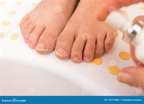 Feet with Fungal Toe Nail Infection Stock Photo - Image of athletes ...