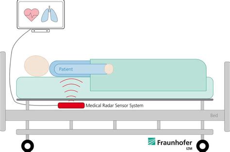 Contactless patient monitoring: ECG using radar
