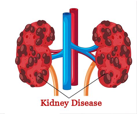 Infections and Chronic Kidney Disease | American Dialysis ...