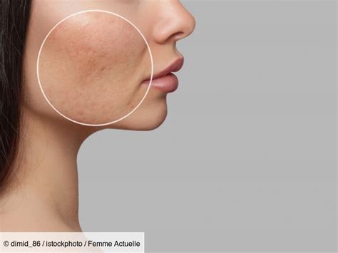 Acné : voici le meilleur ingrédient à utiliser selon une dermatologue