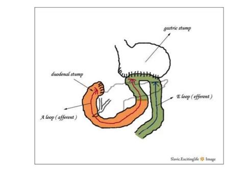 Efferent-Loop-Syndrom || Med-koM